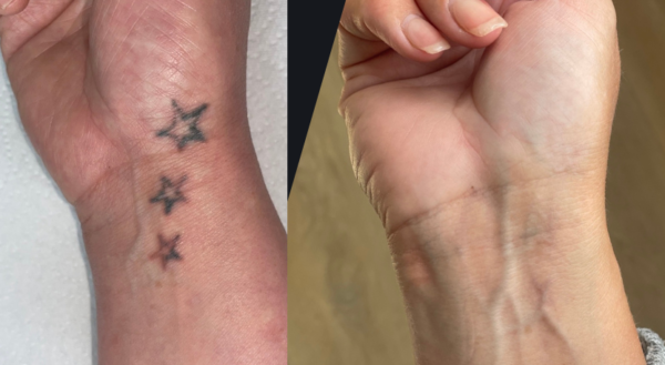 Consultation - Tattoo Removal